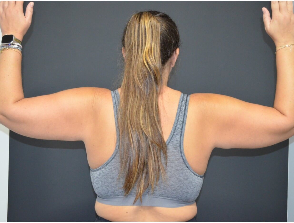 Vaser Lipo- arms, tummy chest Before