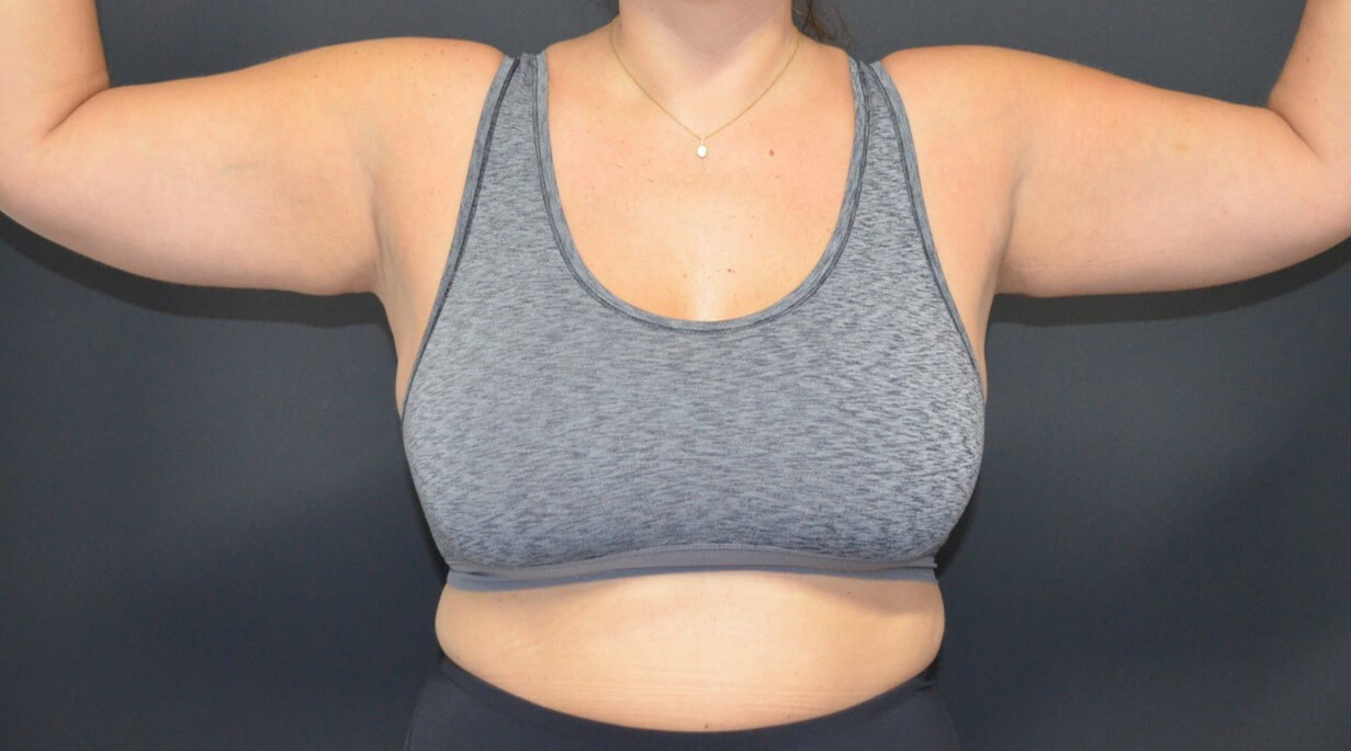 Vaser Lipo- arms, tummy chest Before