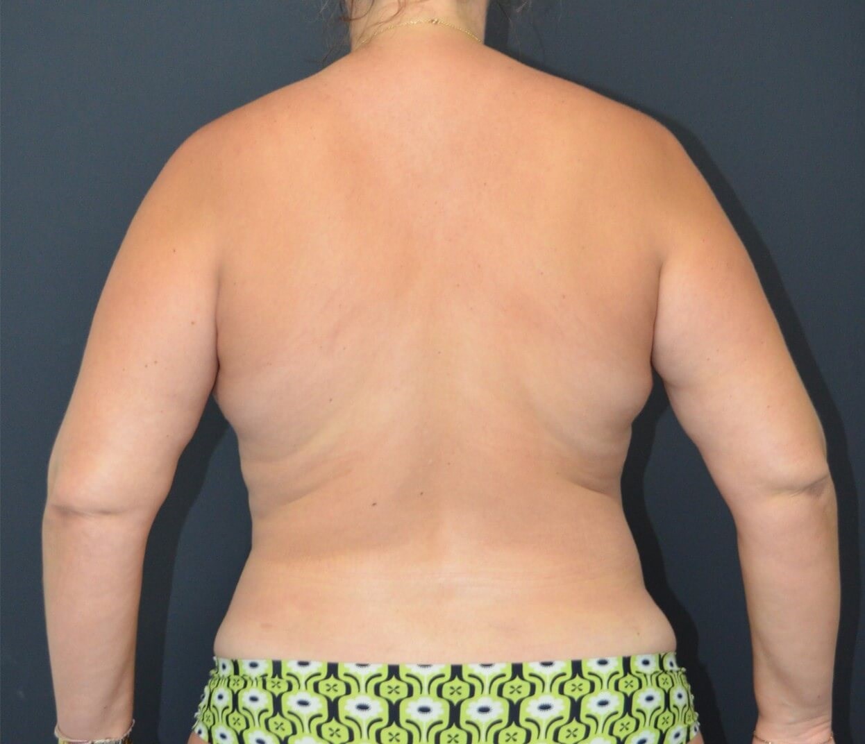 Vaser Lipo- arms, tummy chest After