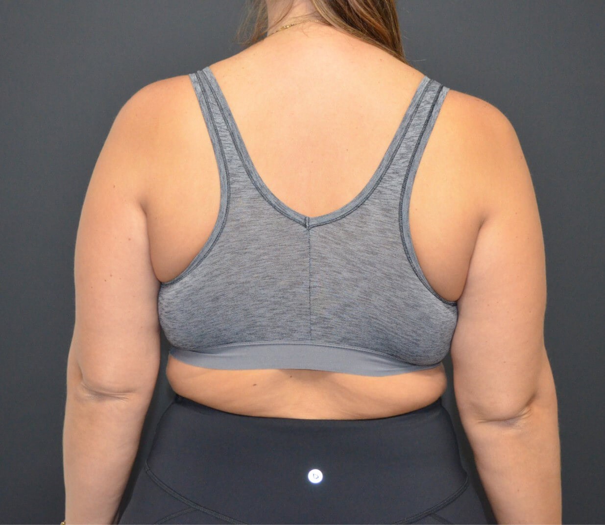 Vaser Lipo- arms, tummy chest Before