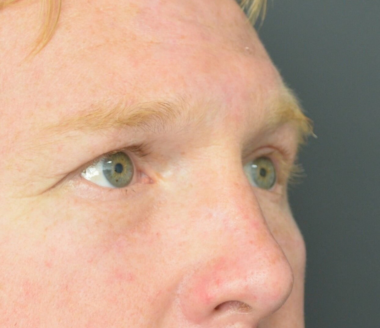 Lower blepharoplasty fat graft After