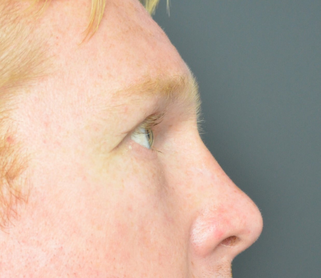 Lower blepharoplasty fat graft After