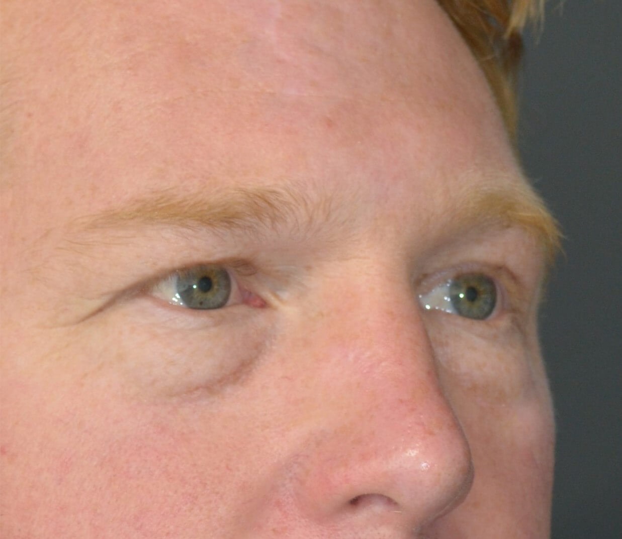 Lower blepharoplasty fat graft Before