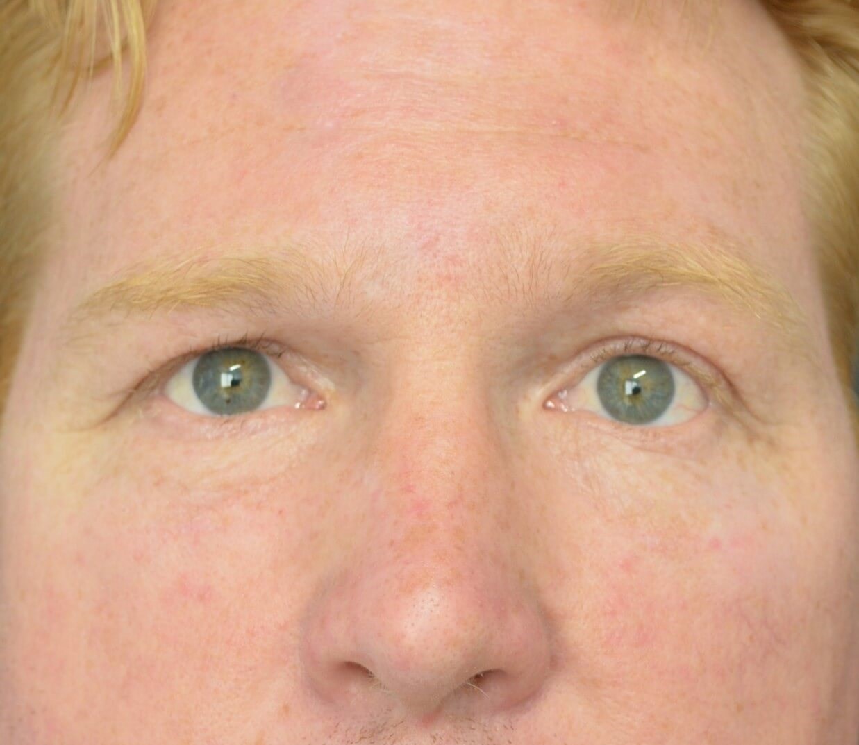 Lower blepharoplasty fat graft After