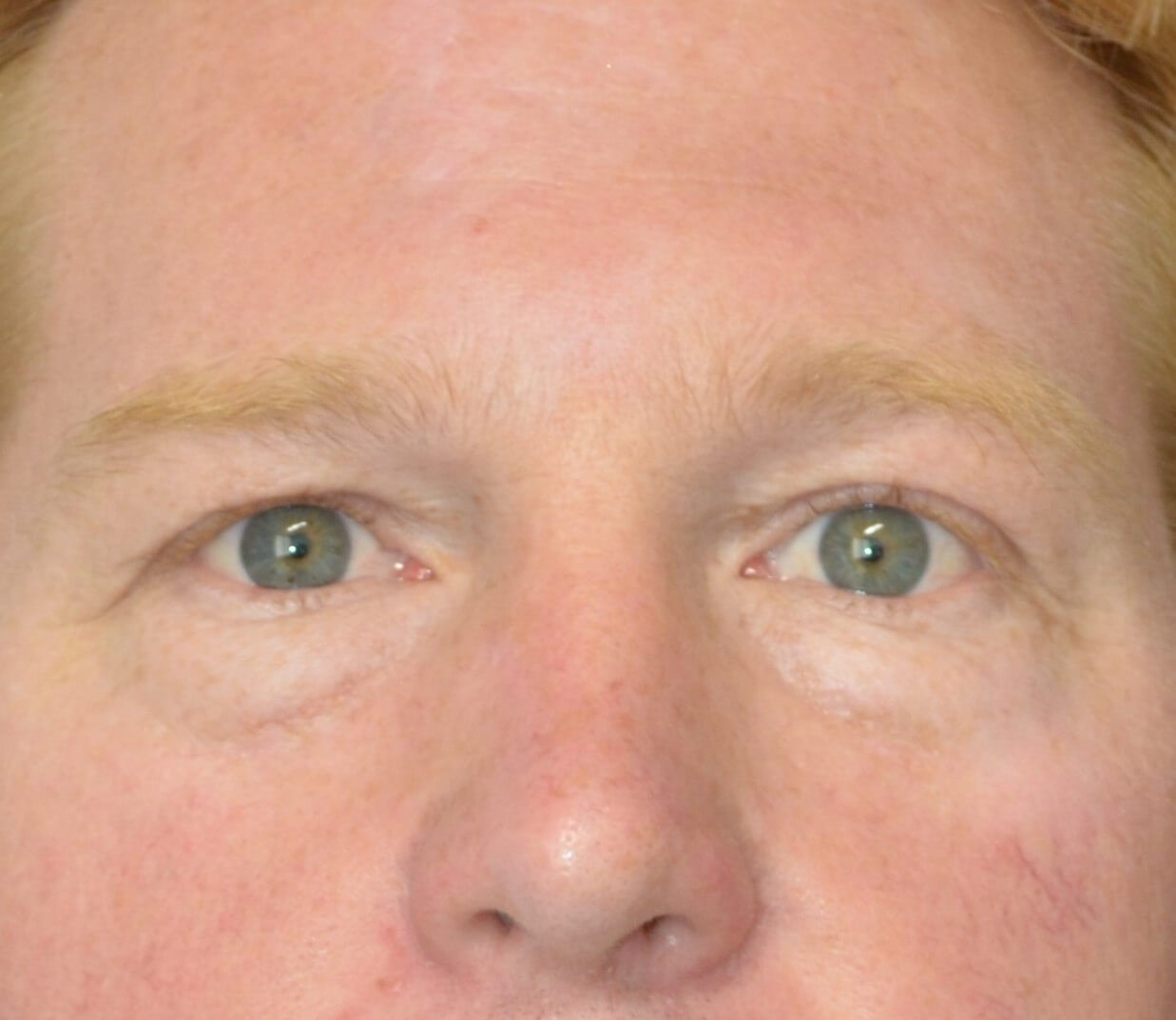 Lower blepharoplasty fat graft Before