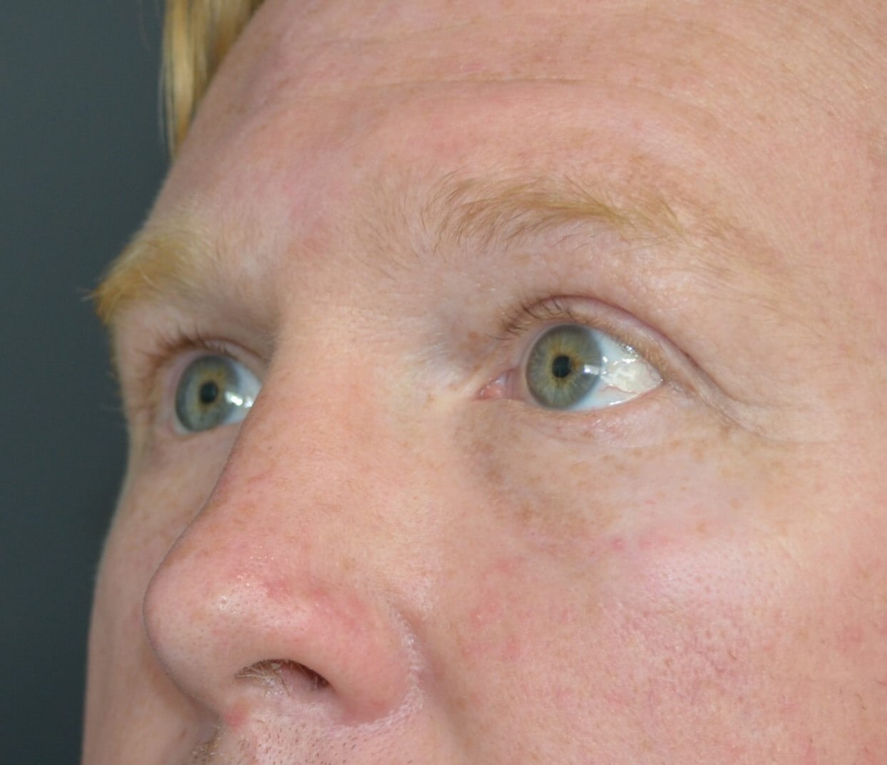Lower blepharoplasty fat graft After