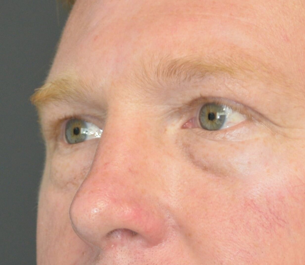 Lower blepharoplasty fat graft Before