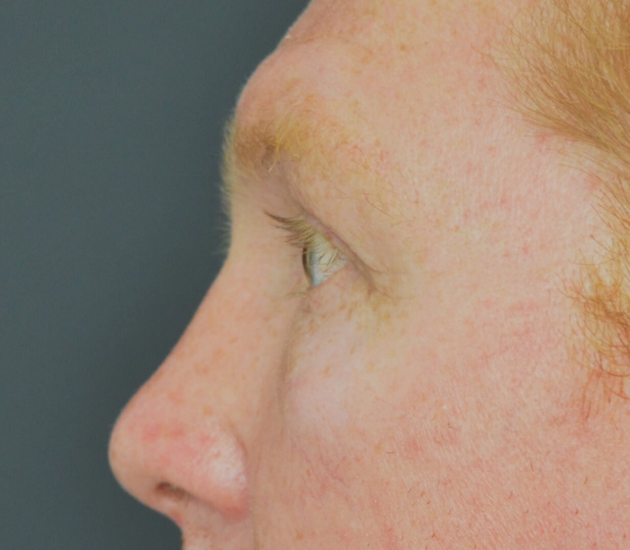 Lower blepharoplasty fat graft After
