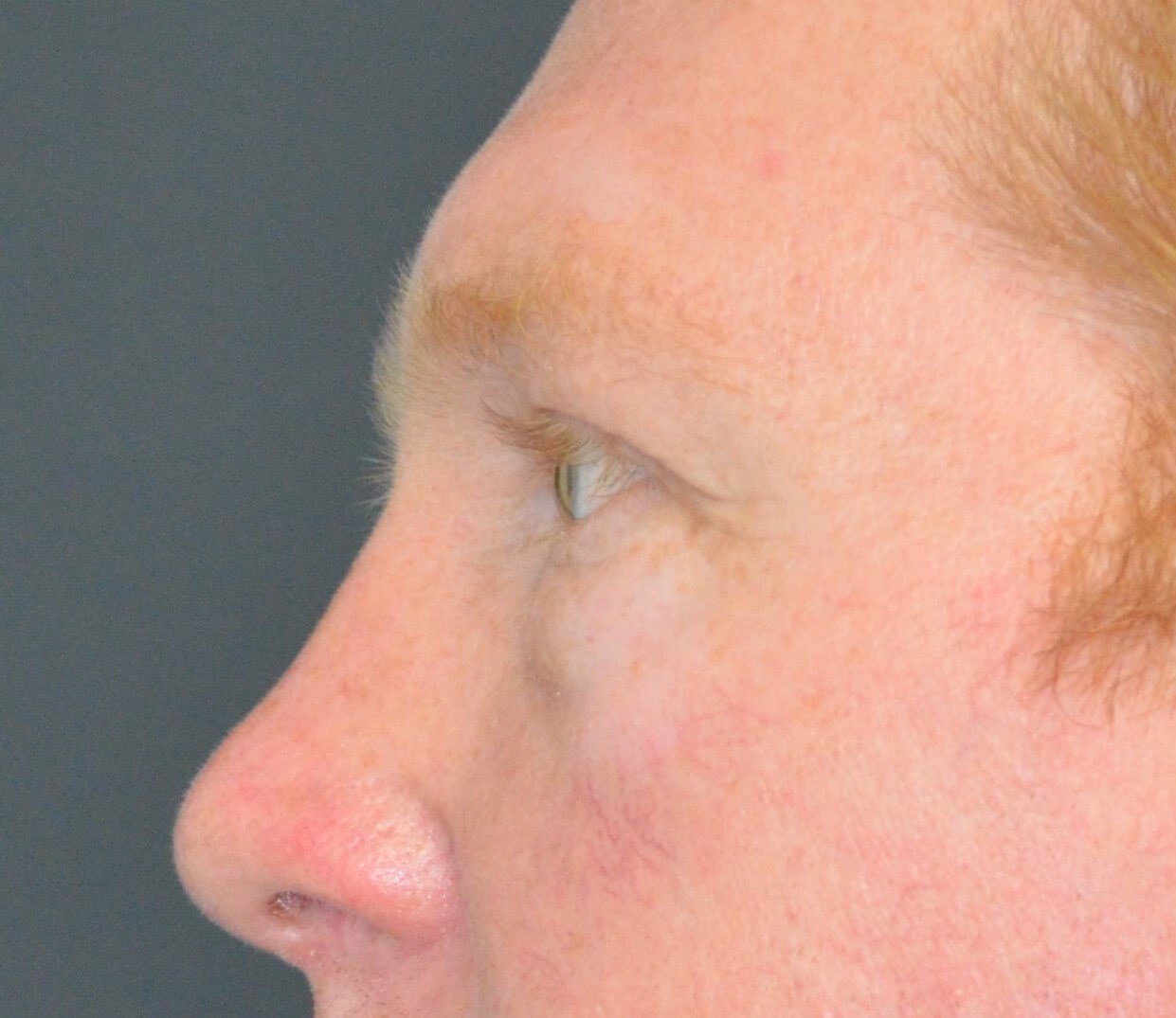 Lower blepharoplasty fat graft Before