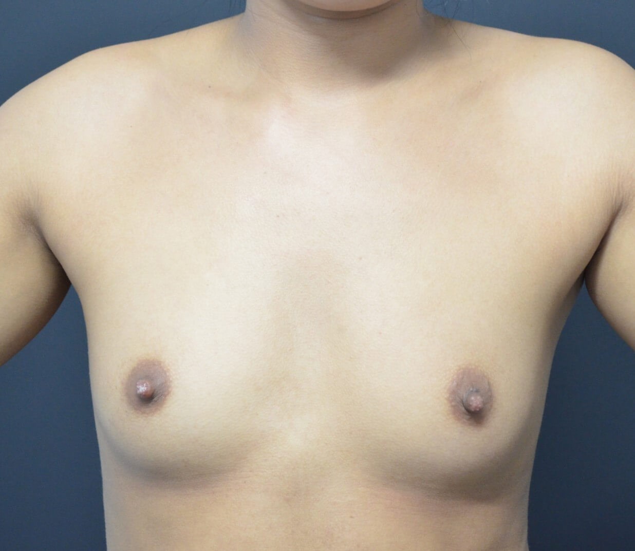 Breast Augmentation 275 cc Before
