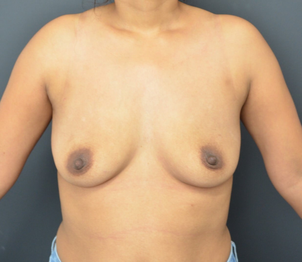 Breast Augmentation 385 cc mod Before