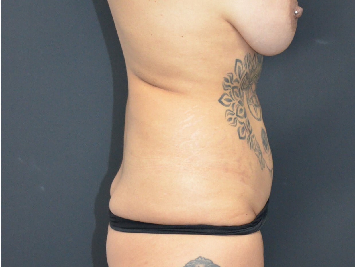 Fleur Di Lis tummy Tuck After