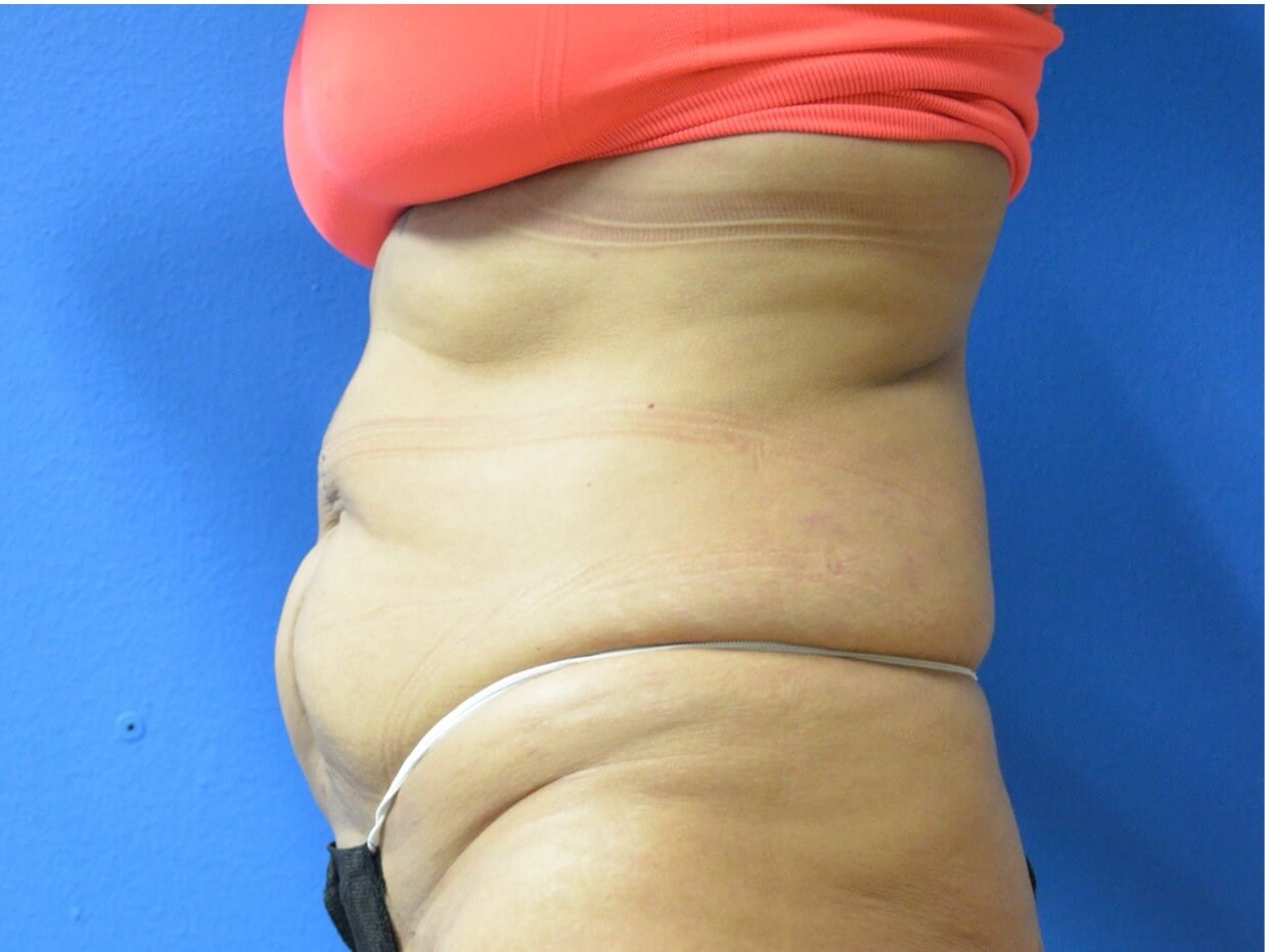 Fleur Di Lis tummy Tuck Before