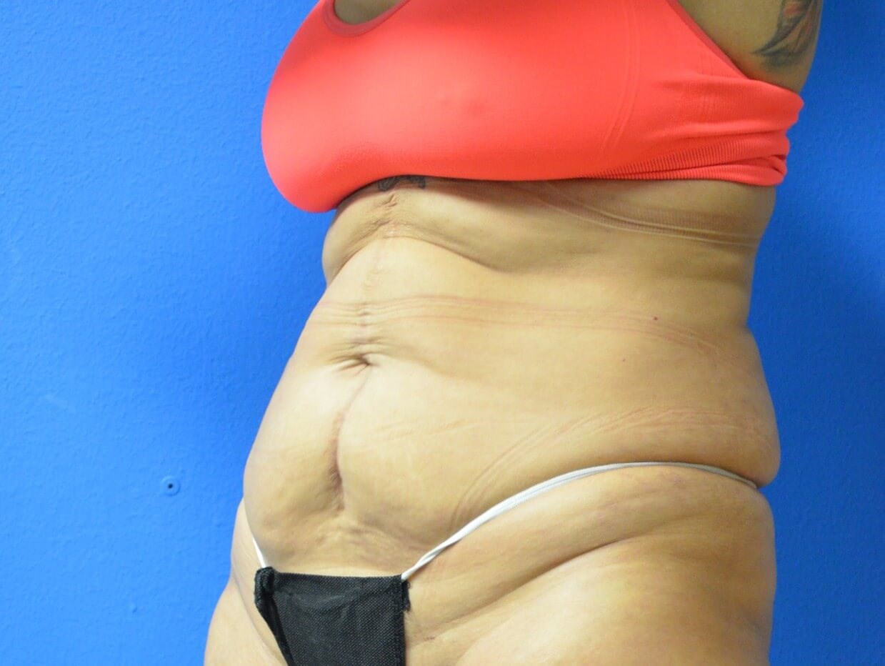 Fleur Di Lis tummy Tuck Before