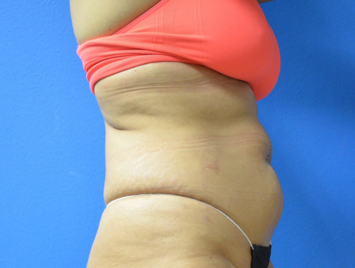 Fleur Di Lis tummy Tuck Before
