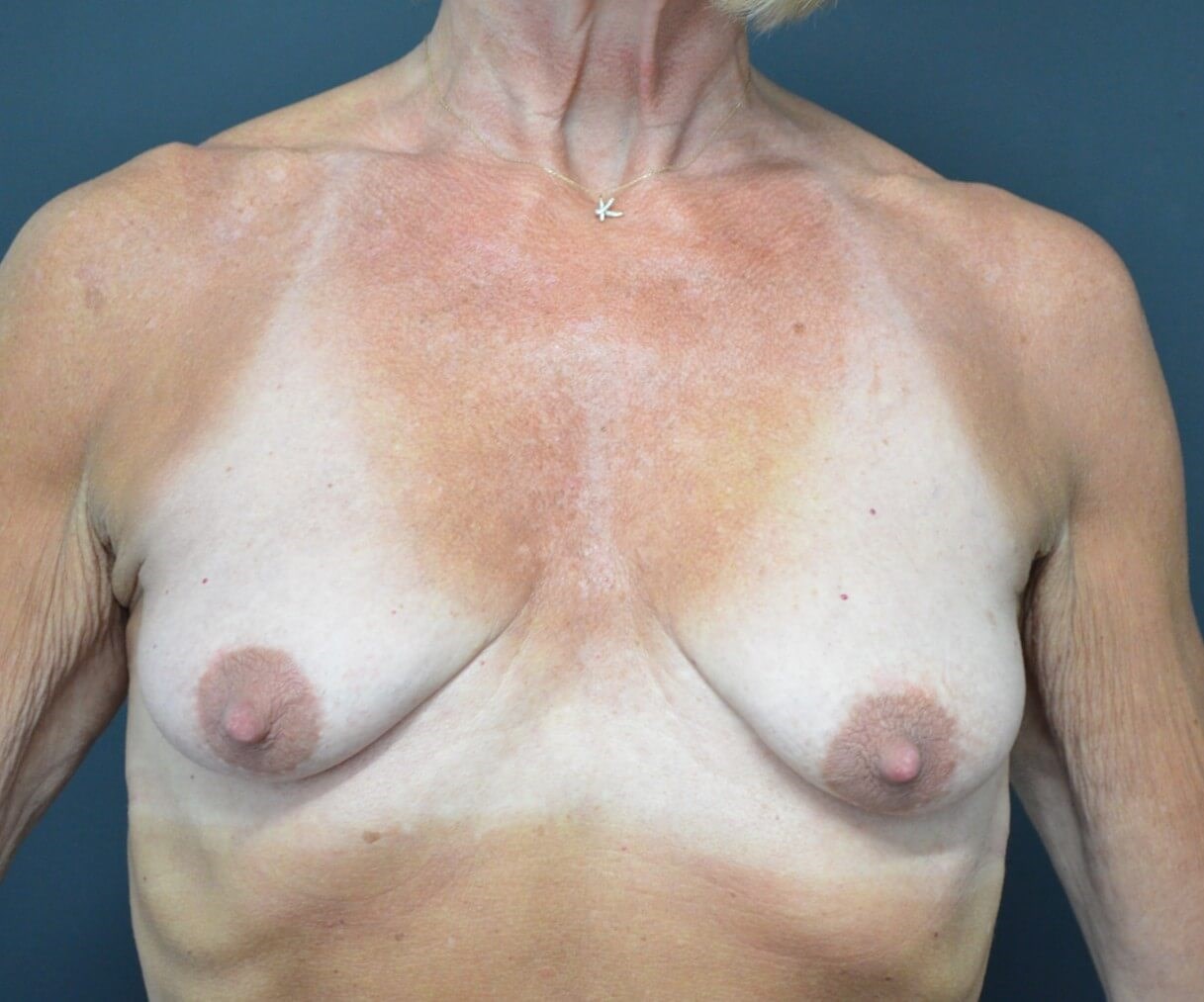 Breastlift augmentation 275cc Before