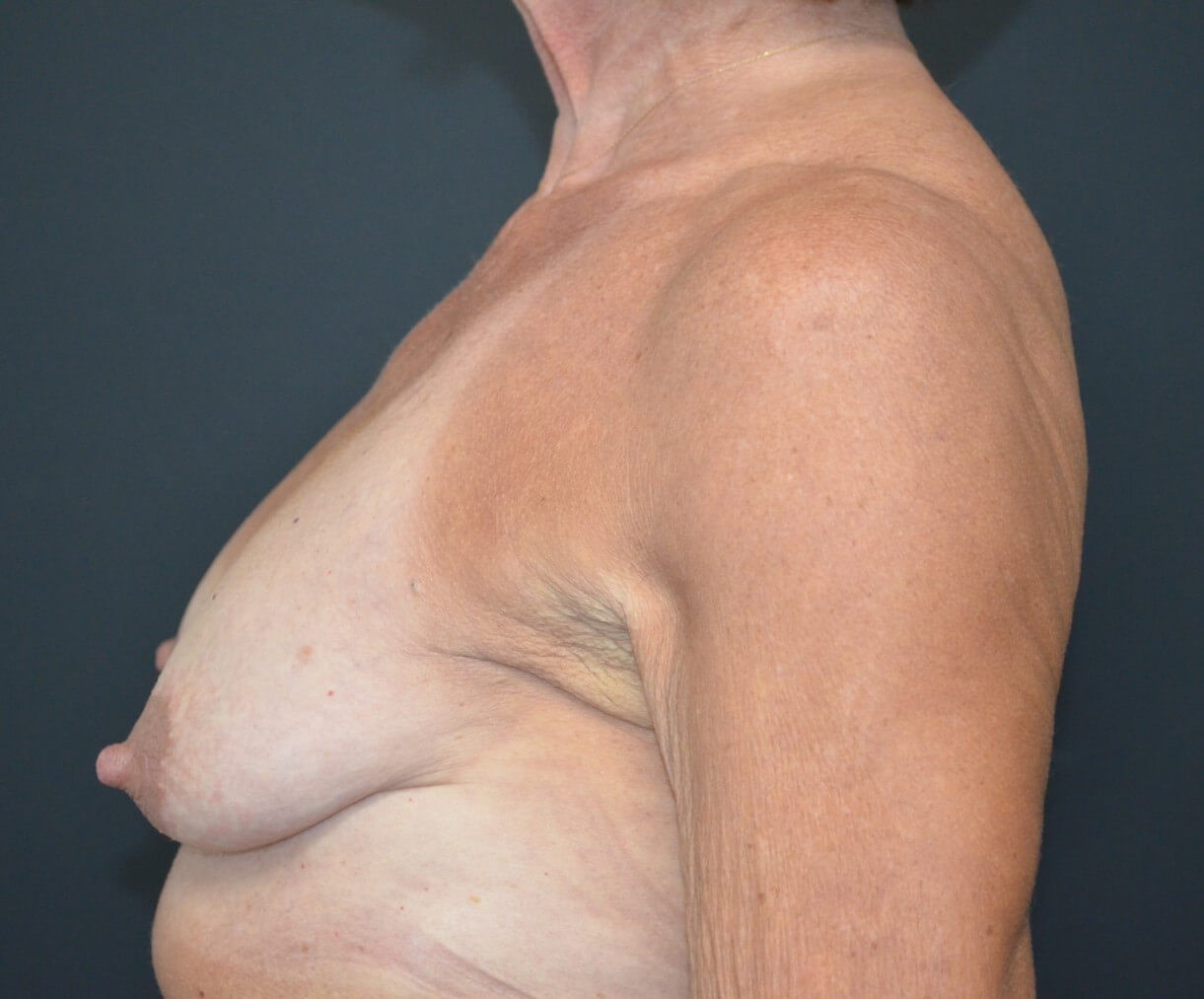 Breastlift augmentation 275cc Before