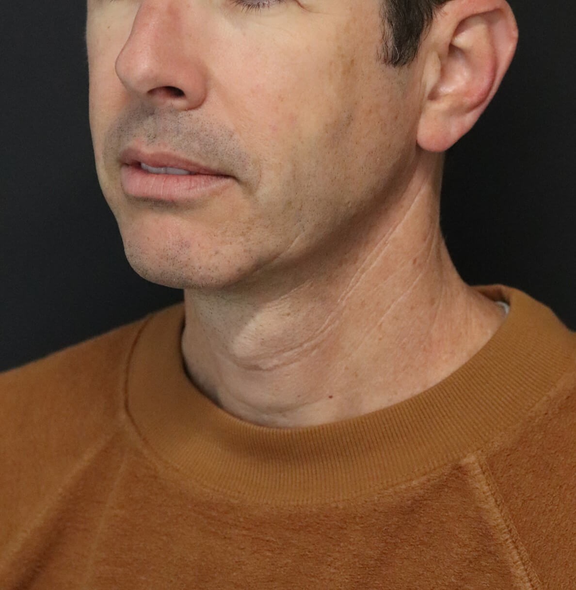 Deep Necklift Chin Fat Tx After