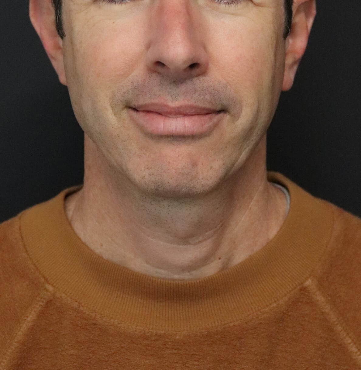 Deep Necklift Chin Fat Tx After