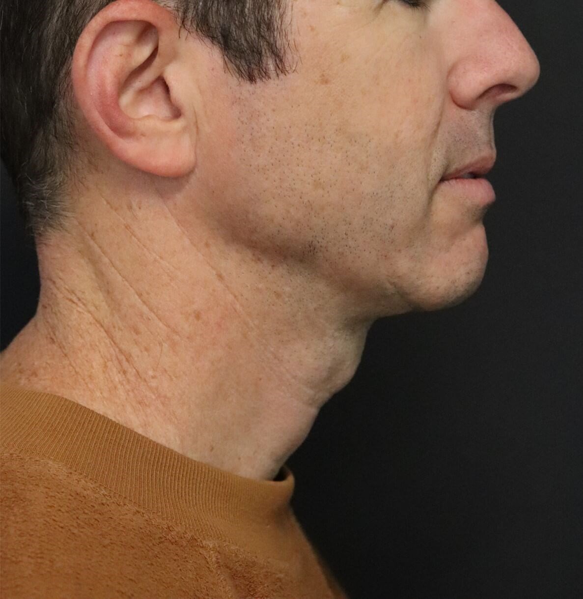 Deep Necklift Chin Fat Tx After