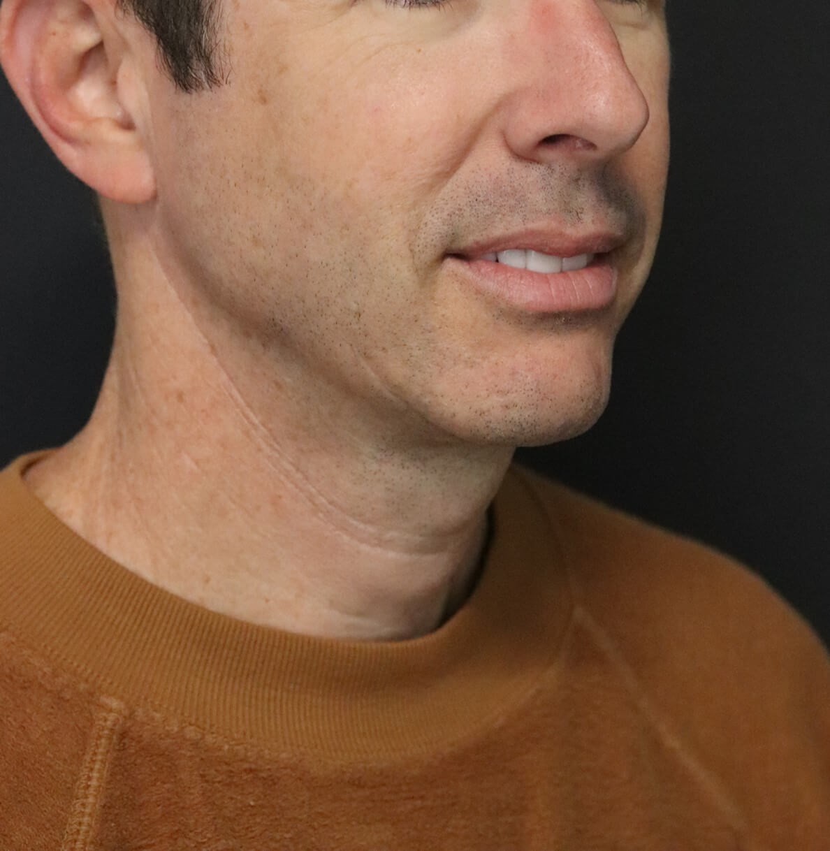 Deep Necklift Chin Fat Tx After