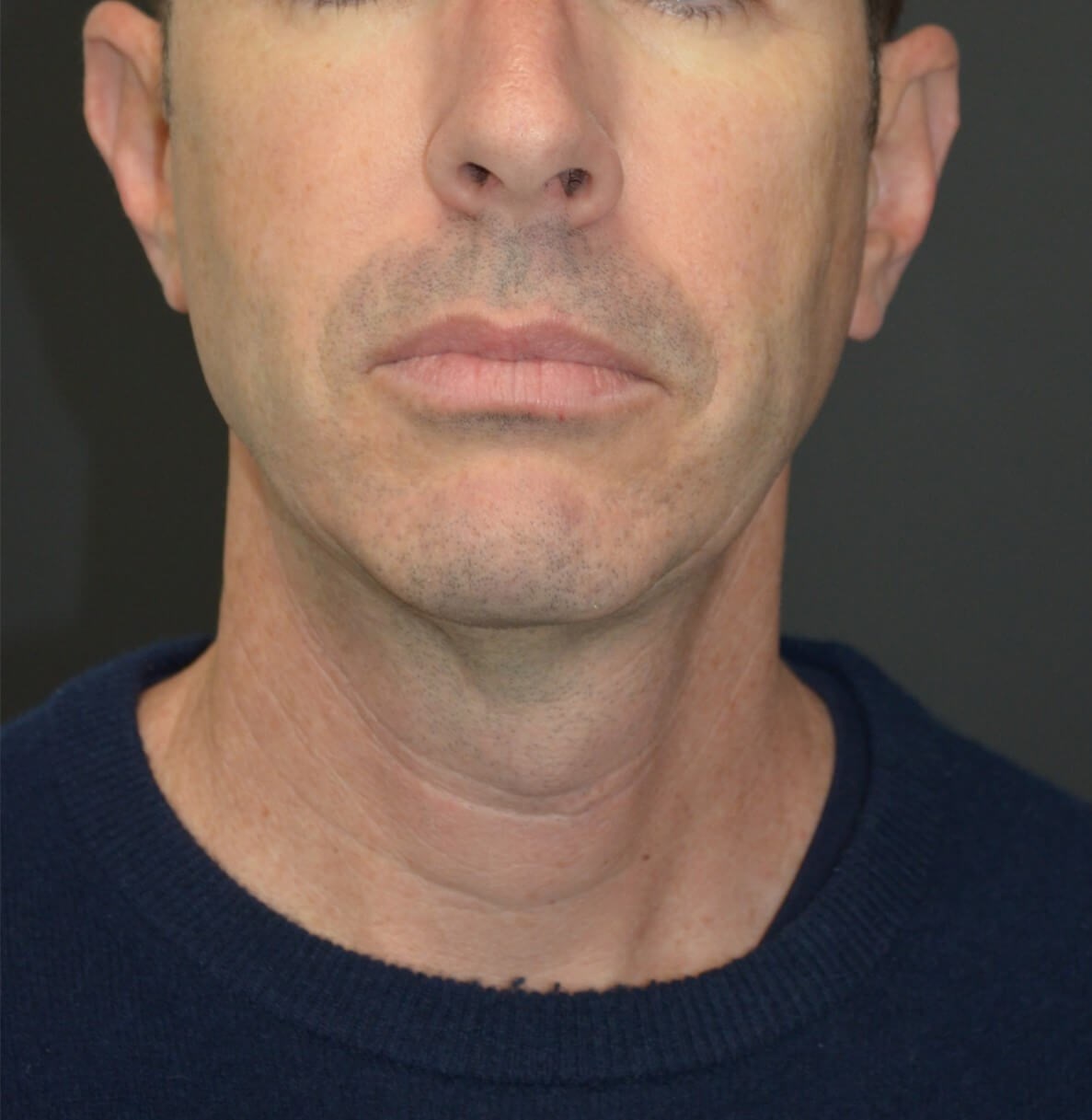 Deep Necklift Chin Fat Tx Before