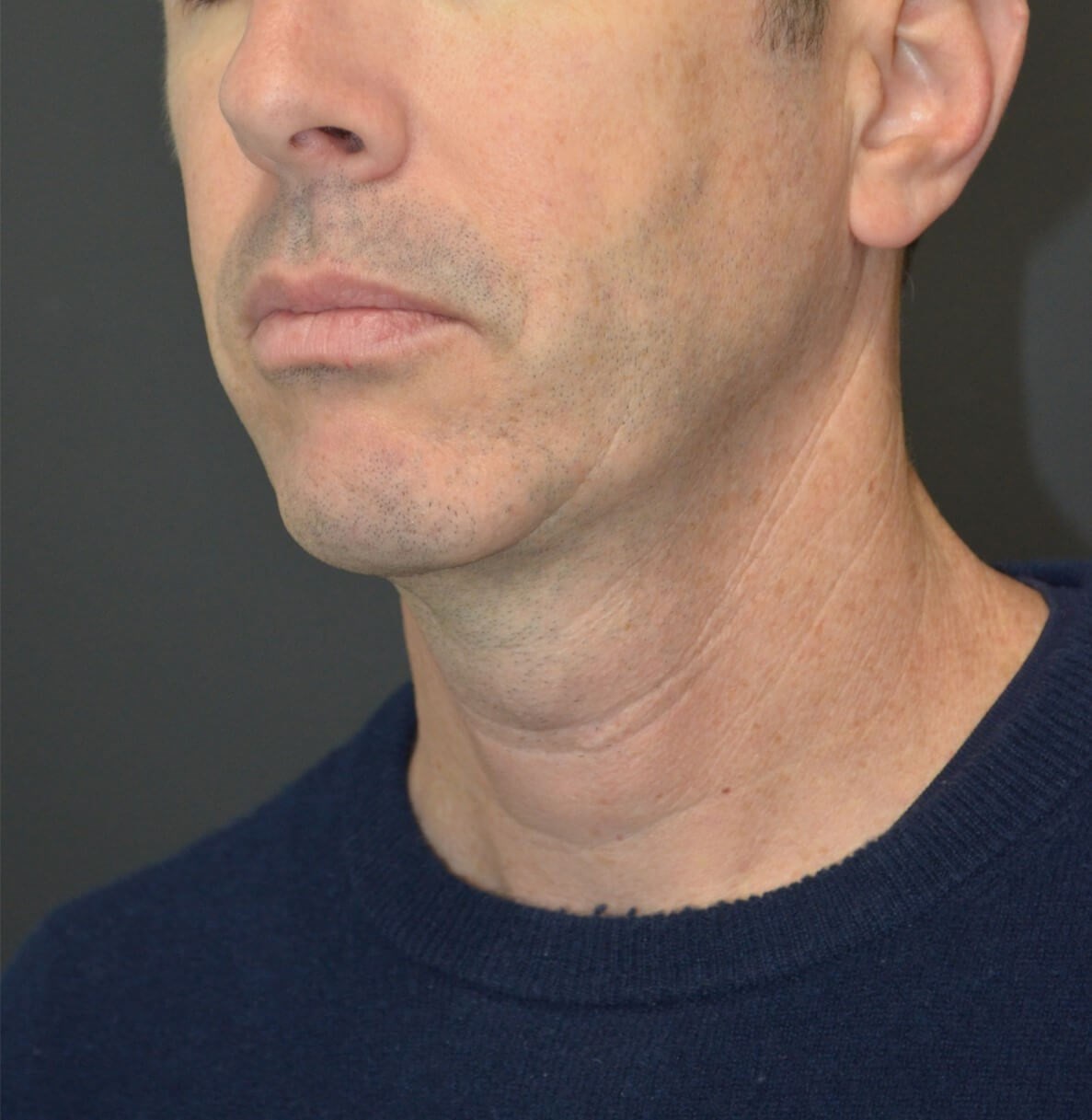 Deep Necklift Chin Fat Tx Before