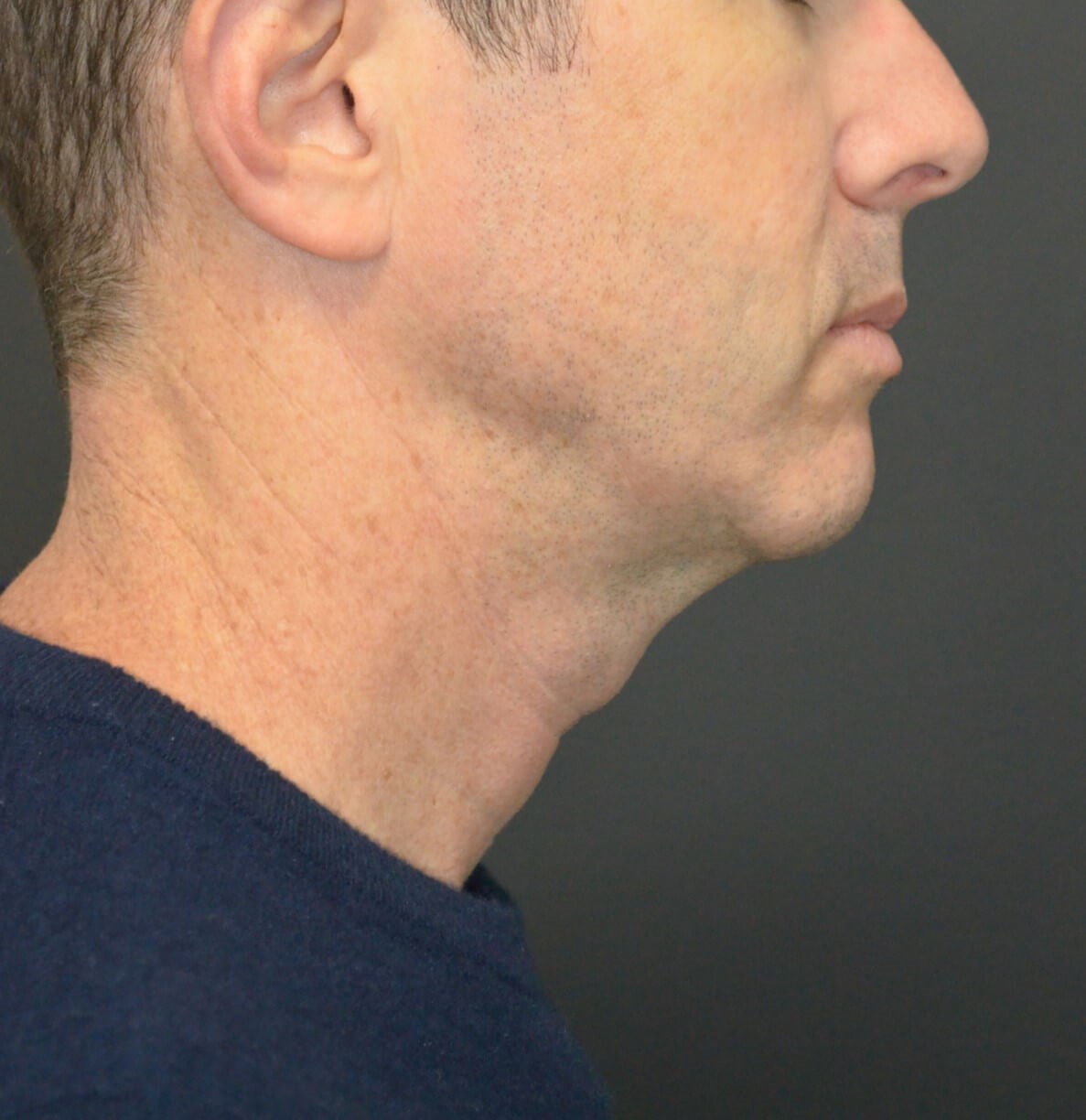 Deep Necklift Chin Fat Tx Before