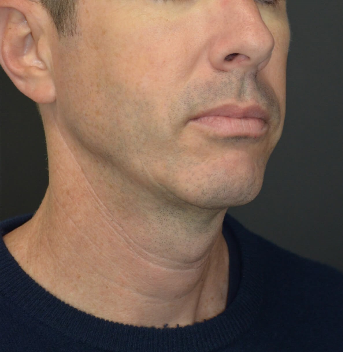 Deep Necklift Chin Fat Tx Before