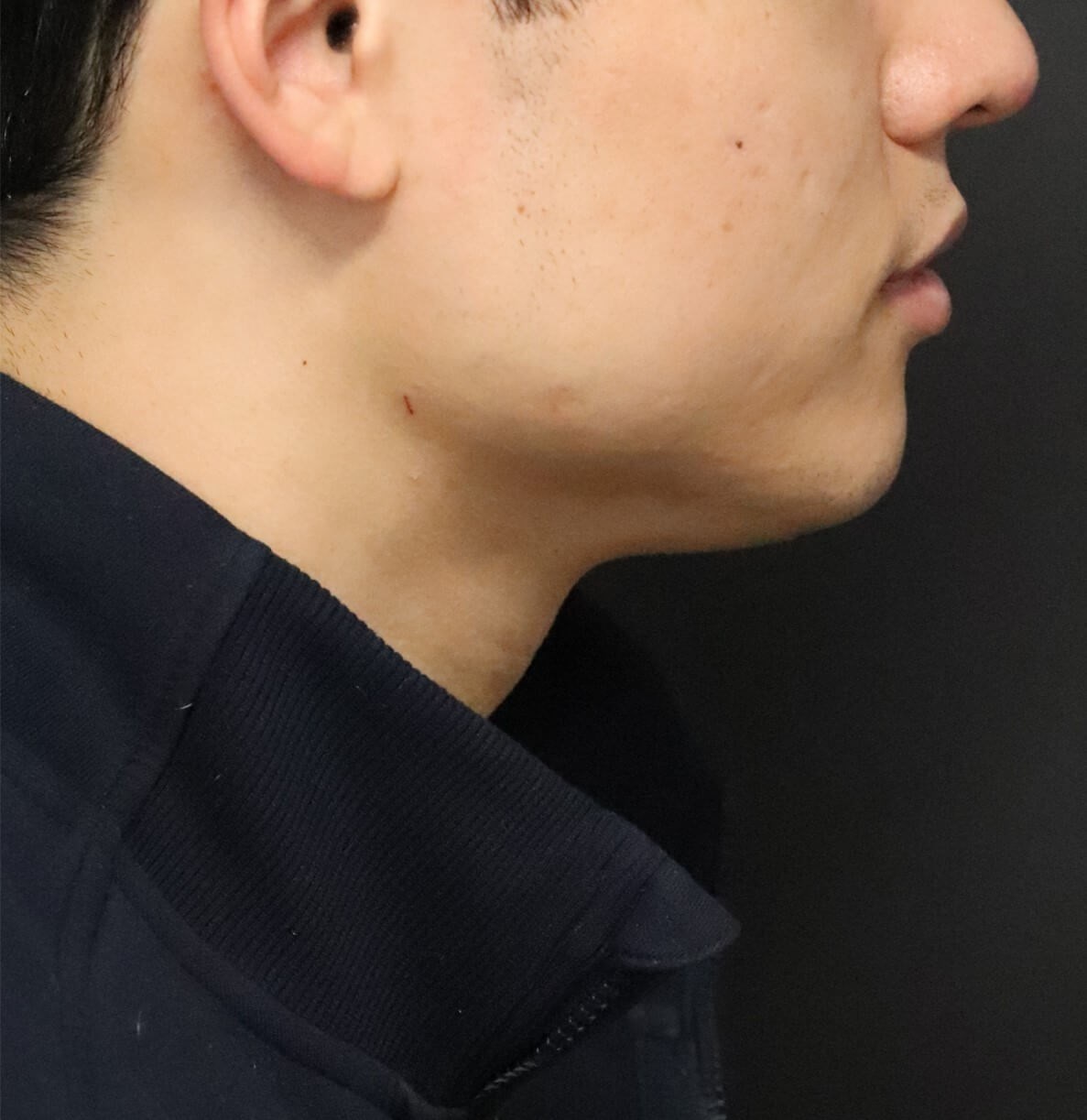 Deep Neck Contouring -Necklift After