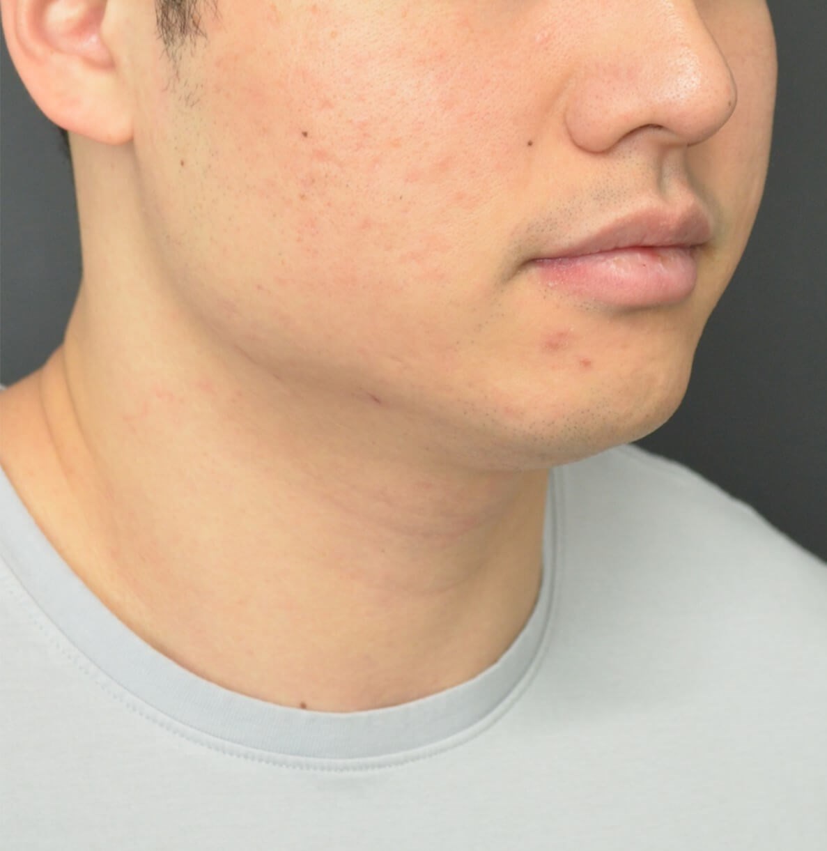 Deep Neck Contouring -Necklift Before