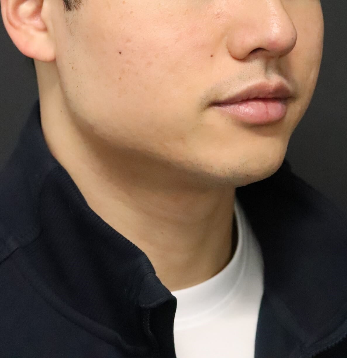Deep Neck Contouring -Necklift After