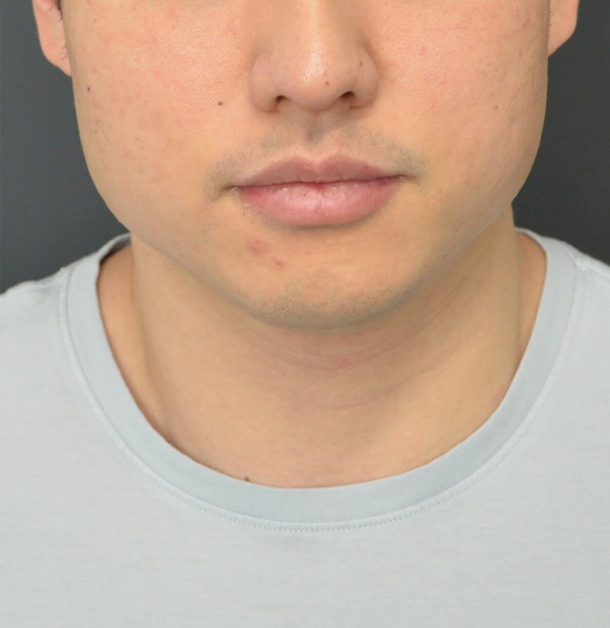 Deep Neck Contouring -Necklift Before