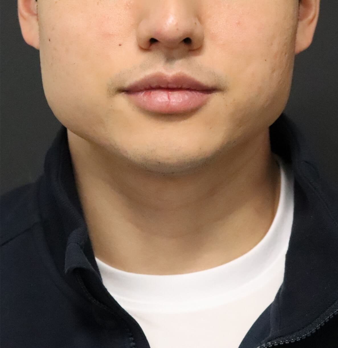 Deep Neck Contouring -Necklift After