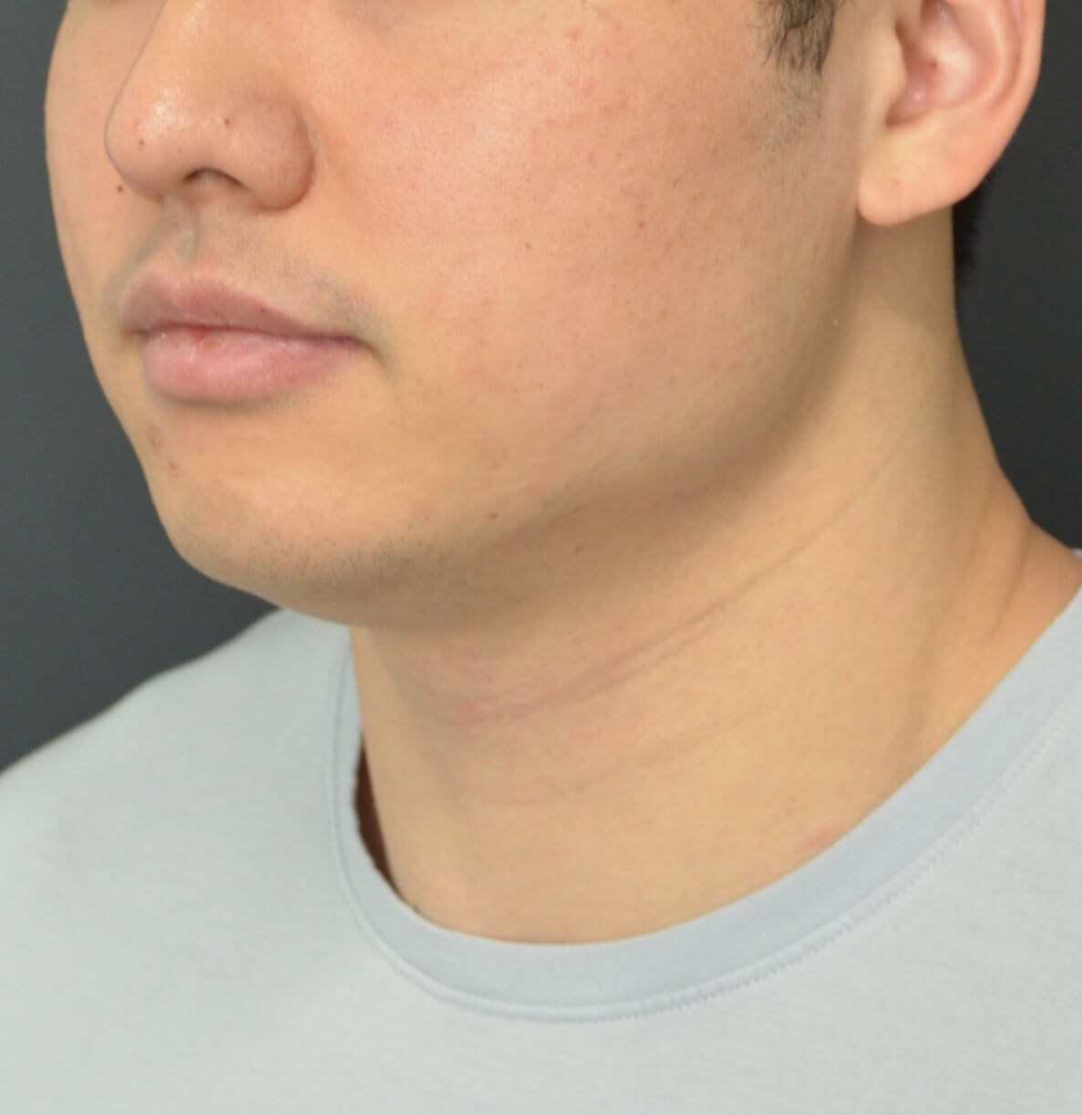 Deep Neck Contouring -Necklift Before