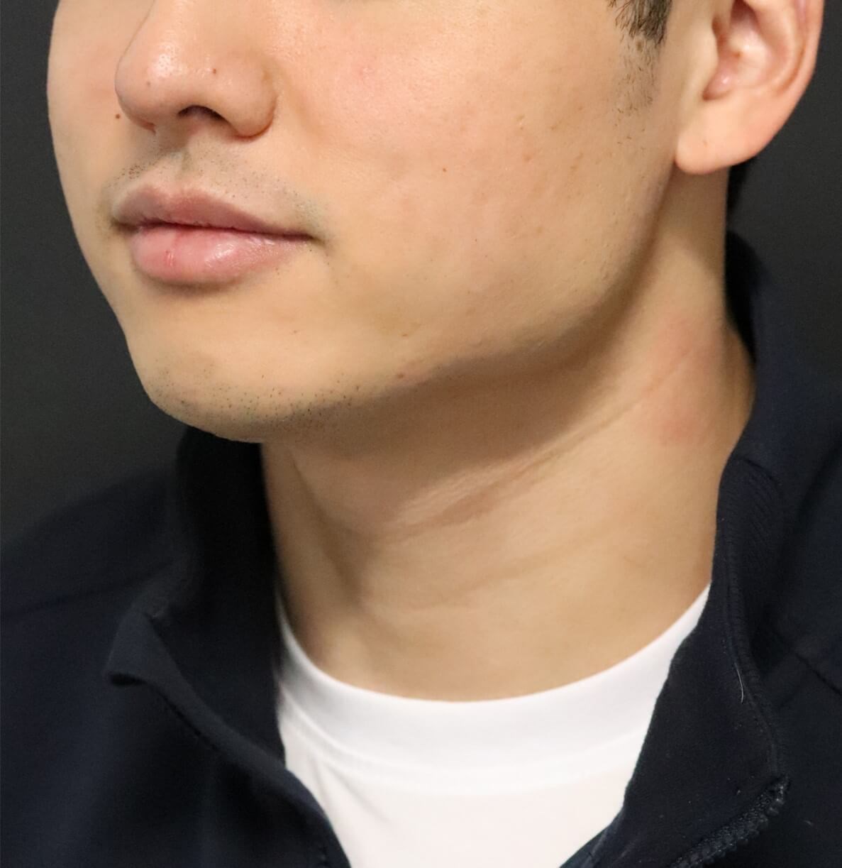 Deep Neck Contouring -Necklift After