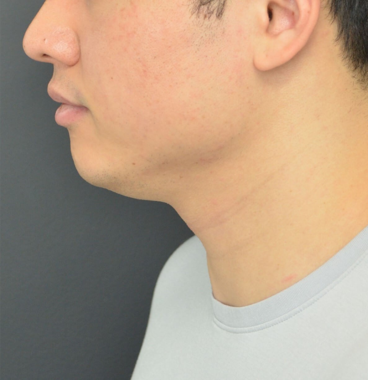 Deep Neck Contouring -Necklift Before