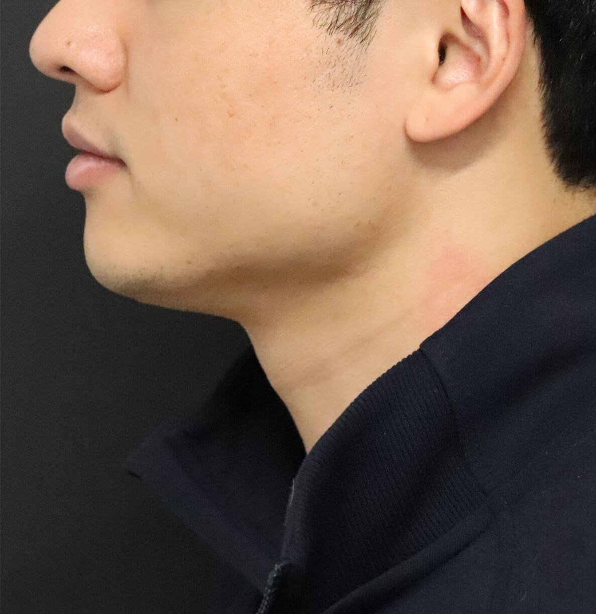 Deep Neck Contouring -Necklift After