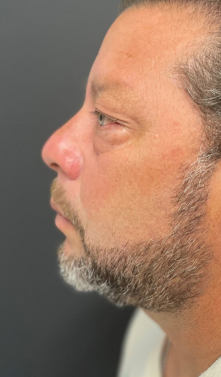 Male Lower Lid Blepharoplasty Before