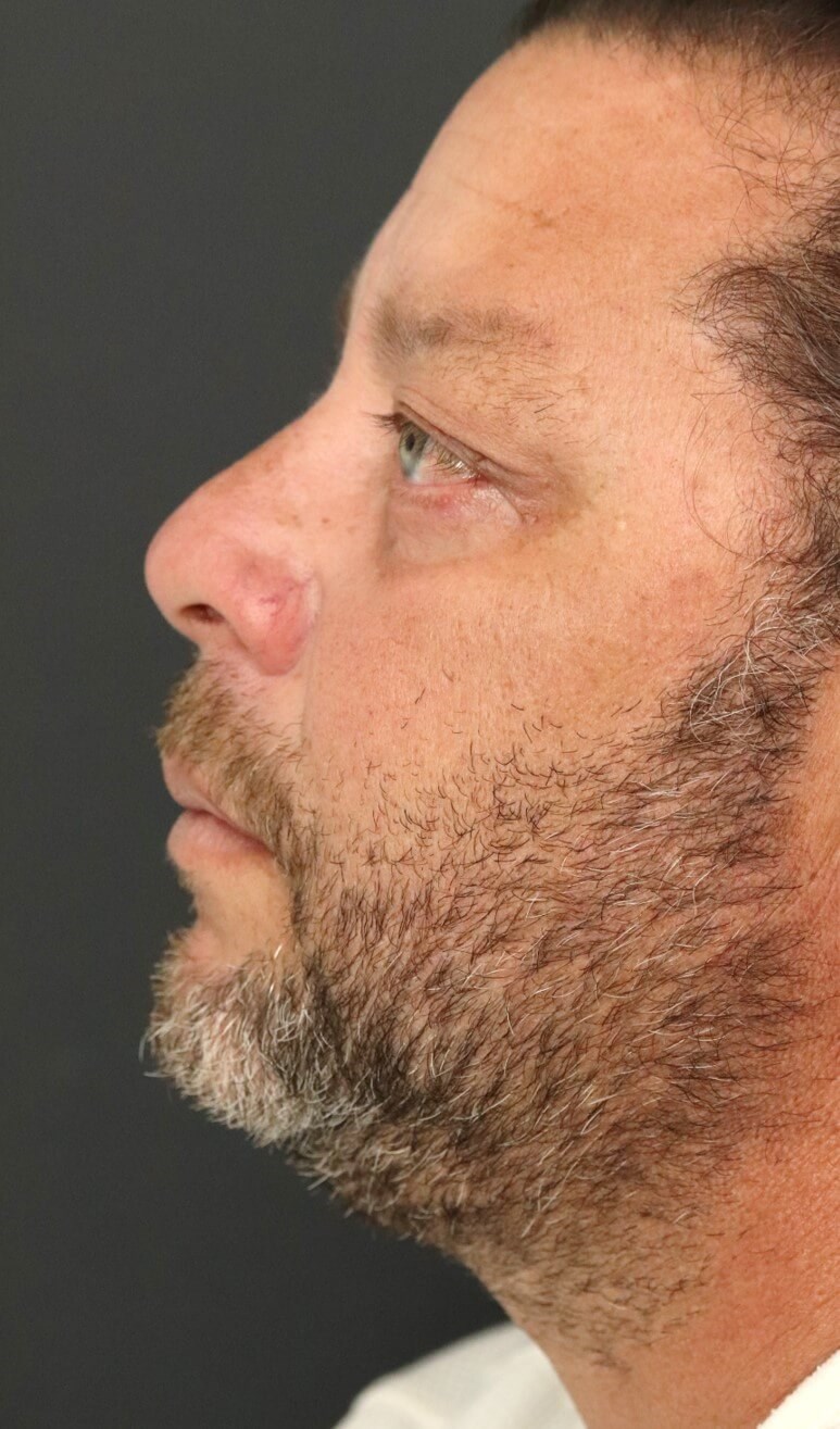 Male Lower Lid Blepharoplasty After