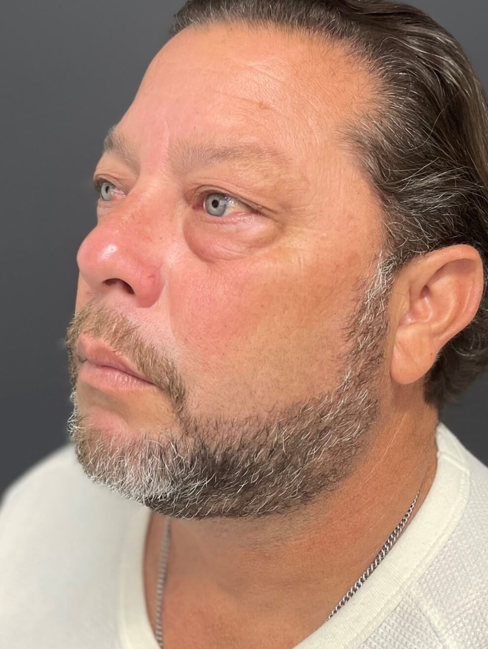 Male Lower Lid Blepharoplasty Before