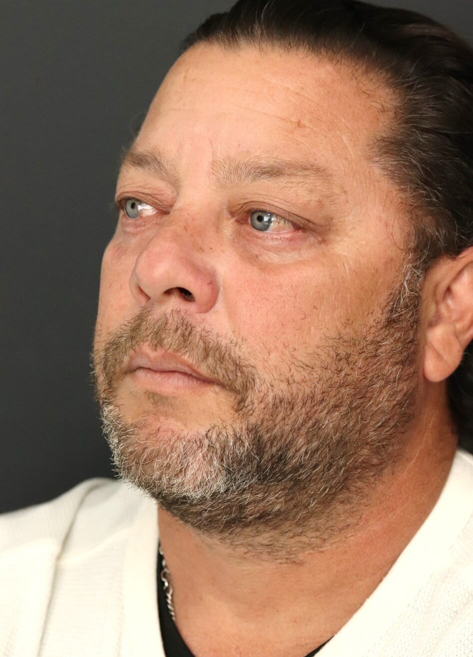 Male Lower Lid Blepharoplasty After