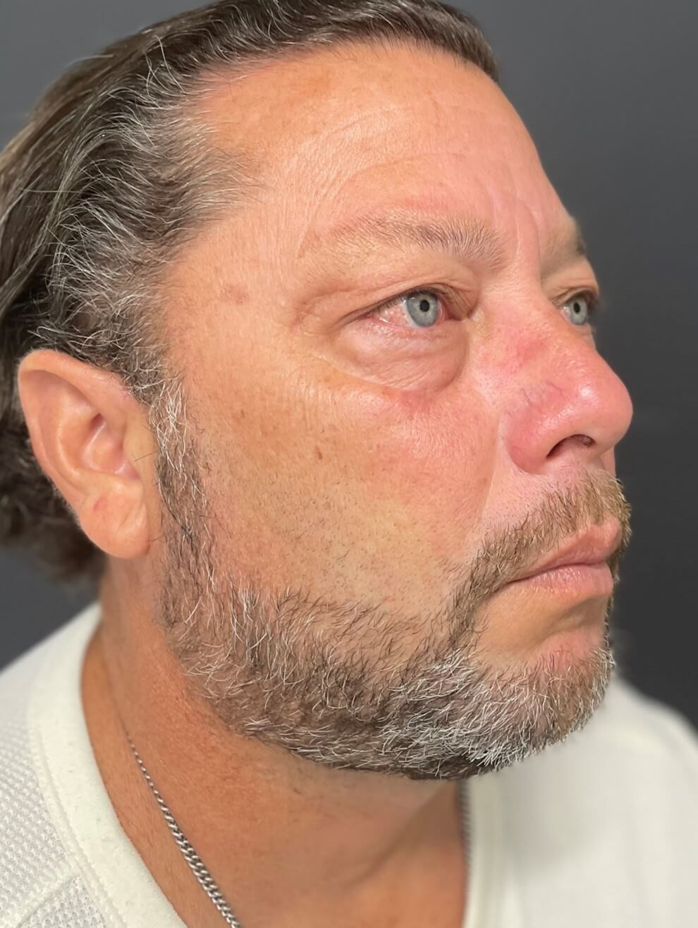 Male Lower Lid Blepharoplasty Before