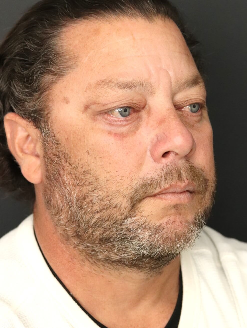 Male Lower Lid Blepharoplasty After