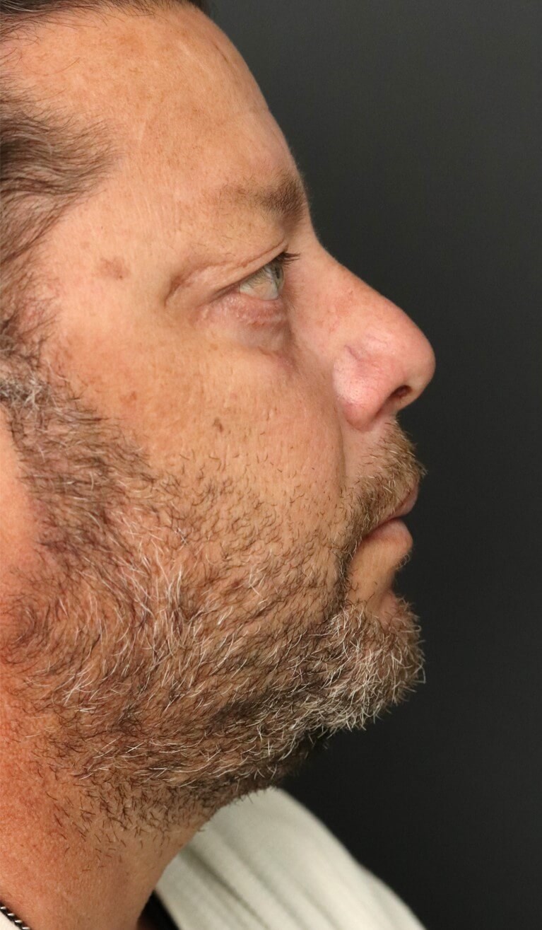 Male Lower Lid Blepharoplasty After