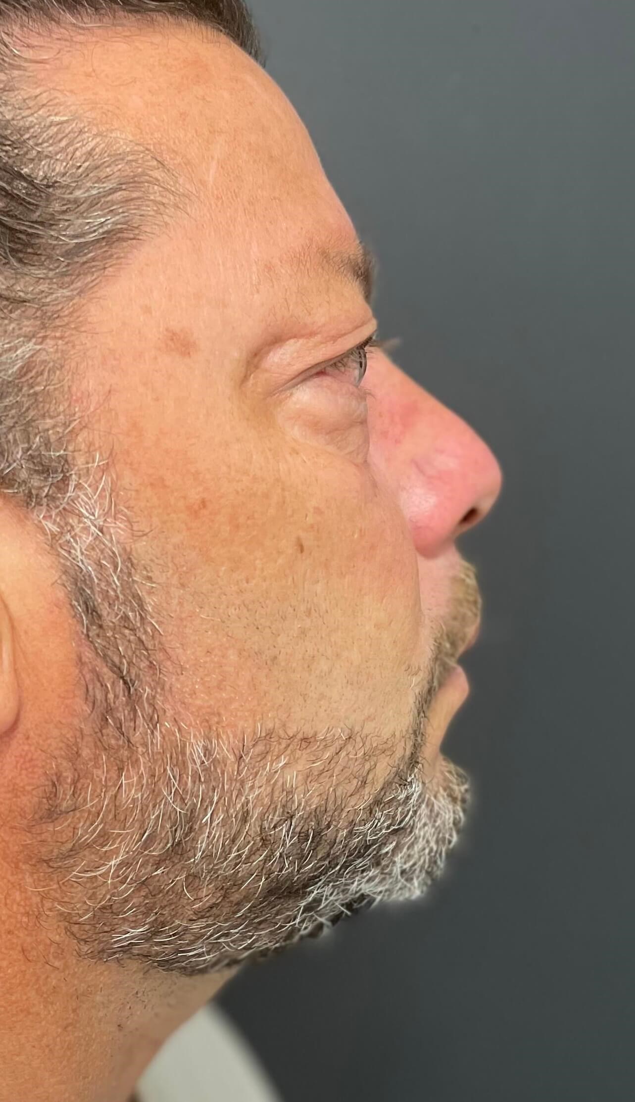 Male Lower Lid Blepharoplasty Before