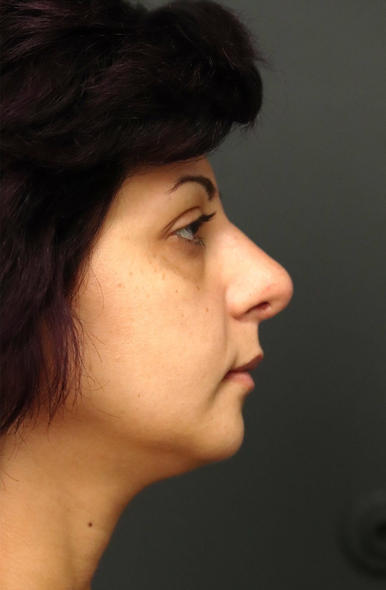 Rhinoplasty with tip rotation After