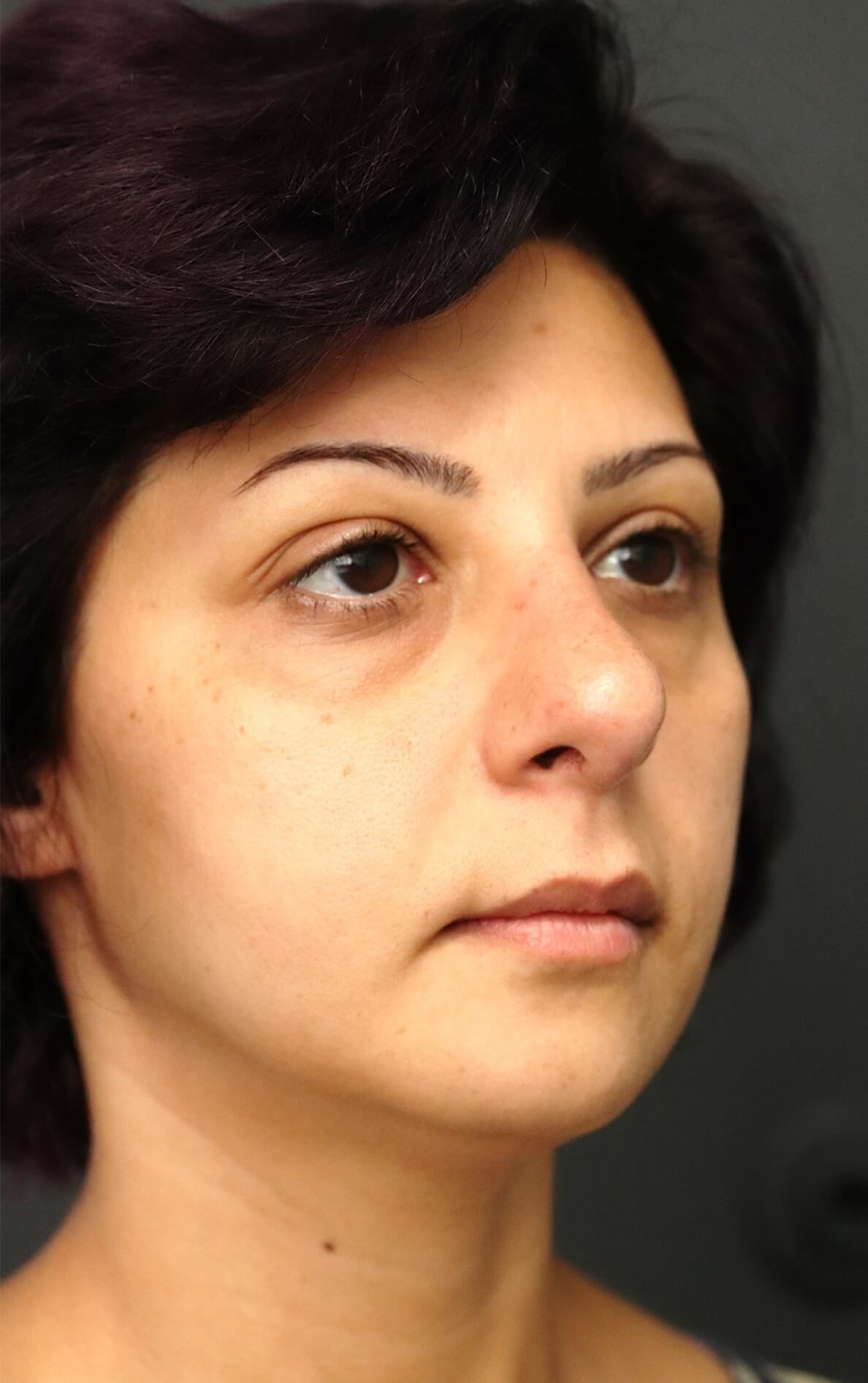 Before and after Rhinoplasty After