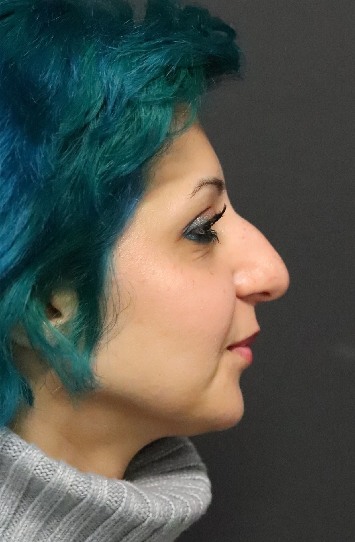 Rhinoplasty with tip rotation Before