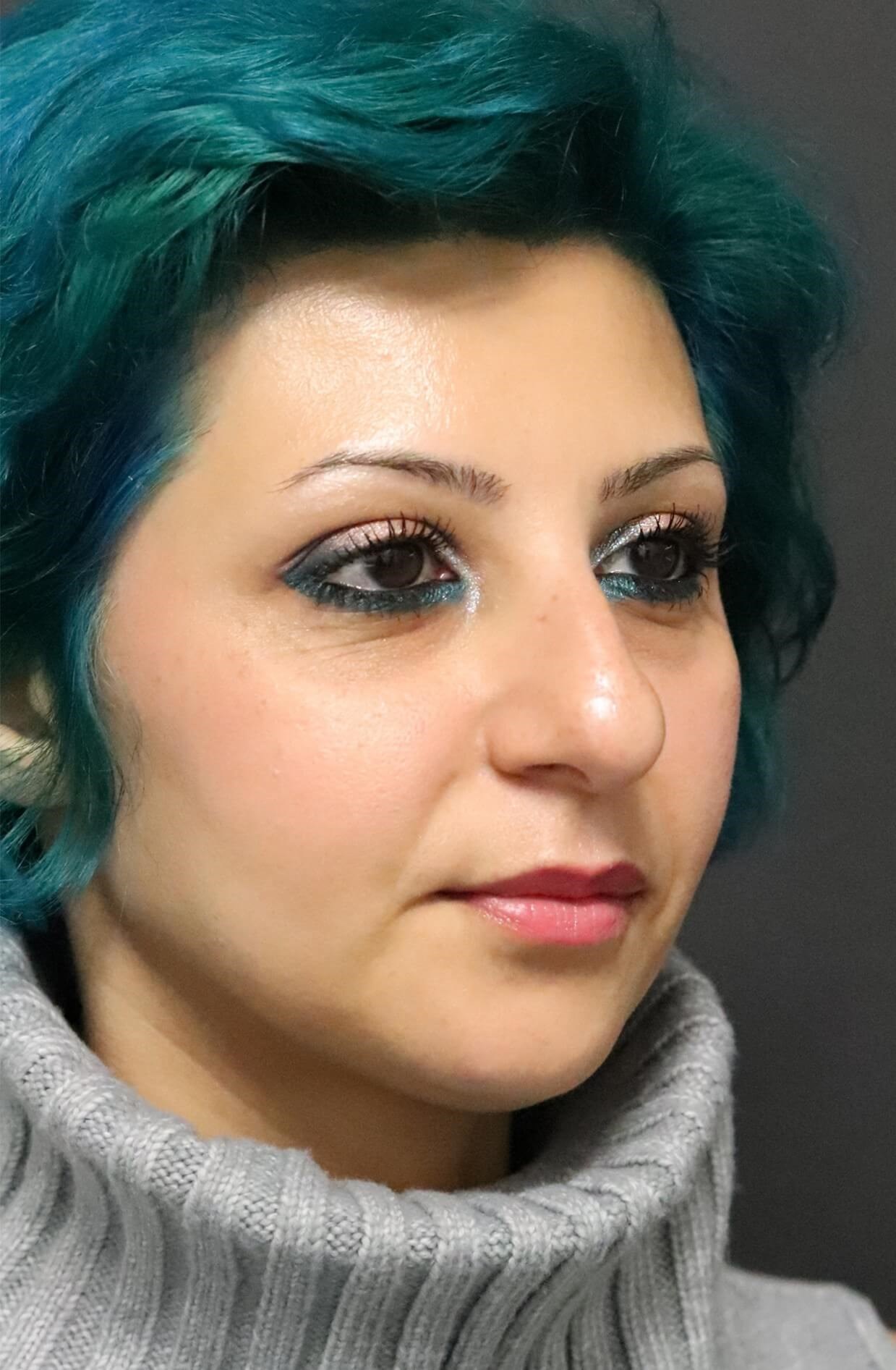 Before and after Rhinoplasty Before